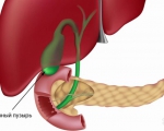 Заболевания желчного пузыря